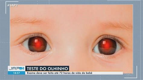 Teste Do Olhinho Até Quantos Meses - Vídeo: Médicos ressaltam importância do teste do olhinho, que deve ser ...