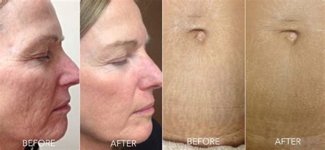 Home Micro Needling Before And After