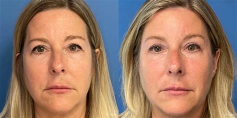 Brow Lift Before & After Gallery