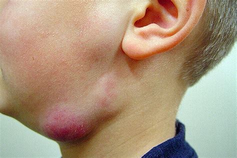 O Que É Linfadenite - Linfadenite submandibular em adultos e crianças: causas, sintomas ...