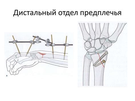 Повреждения кисти и предплечья - презентация онлайн