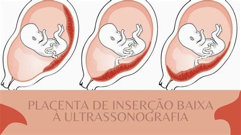Placenta De Inserção Tópica Posterior