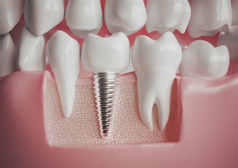 dental implants    work