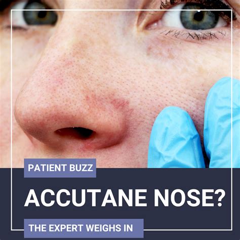 accutane  severe acne archives  steps  dermatology
