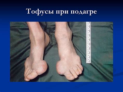 Синдромы при поражении суставов и позвоночника - презентация онлайн
