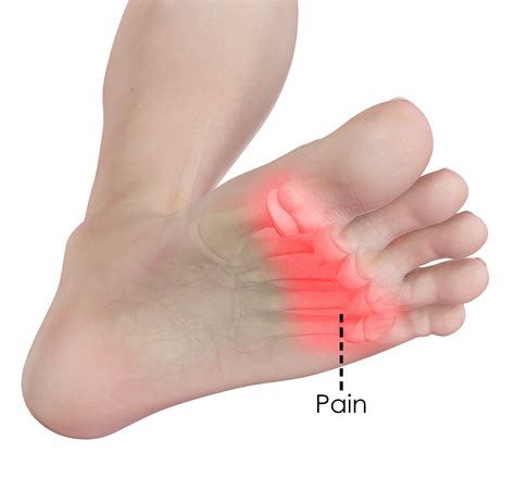 Can Sciatica Cause Pain In Sole Of Foot at Jesse Marshall blog