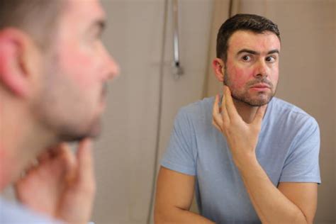 Hives vs. Rash: Key Differences, Causes, and Treatment