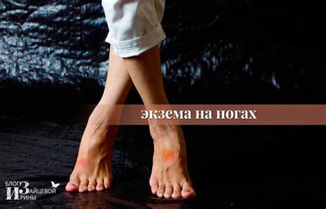 Экзема на ногах. Причины и лечение. Фото