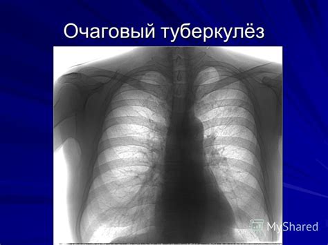 Очаговый туберкулез легких фото