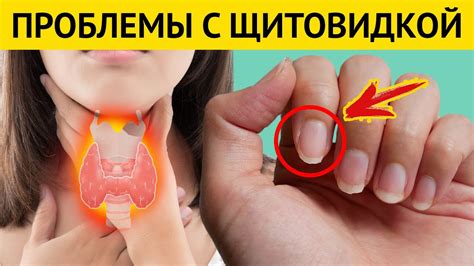 Ваша ЩИТОВИДКА «кричит» о ПРОБЛЕМАХ. Признаки серьезных проблем с ...