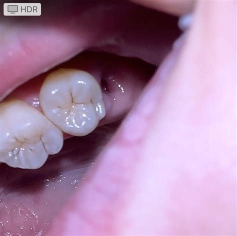 wisdom teeth  removed  days      tight dry feeling