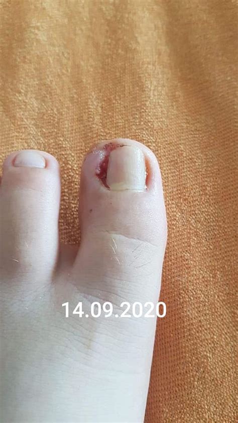 Tratament unghii incarnate Craiova | Unghii deformate | Podologiq Craiova