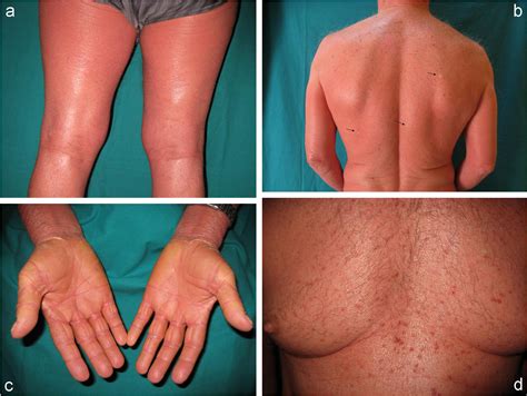 Pitiriasis rubra pilaris acantolítica durante tratamiento con imiquimod