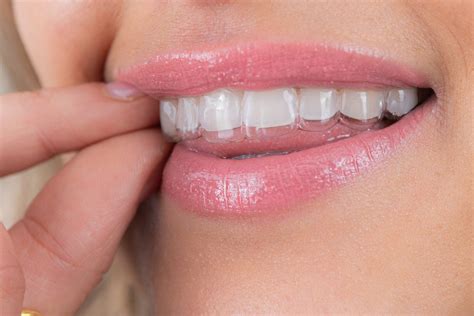 Grow Your Dental Practice | Premium Clear Aligner Partner