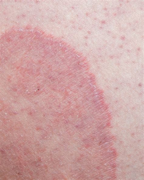 tinea cruris jock itch symptoms  treatment rash id