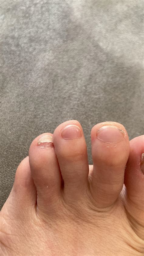 Ingrown Toenail From Climbing Shoes at Myrtle Garza blog