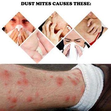 dust mite bites allergic reaction