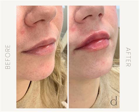 Botox Lip Flip Vs. Lip Filler: Everything You Need To Know | Defy
