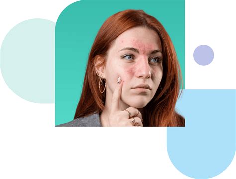 Consult a Rosacea Dermatologist Online