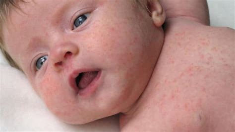 O Que Causa Dermatite Em Bebe - Dermatite Atópica: O que é, causas, sintomas e tratamentos. - Dra ...