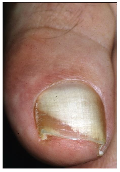 Onychomycosis: A Review