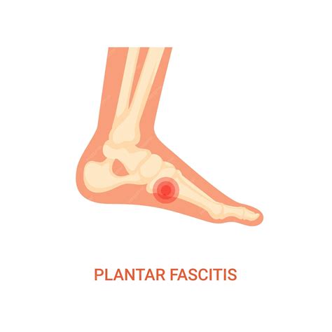 Premium Vector | Diagnosis of plantar fasciitis disease