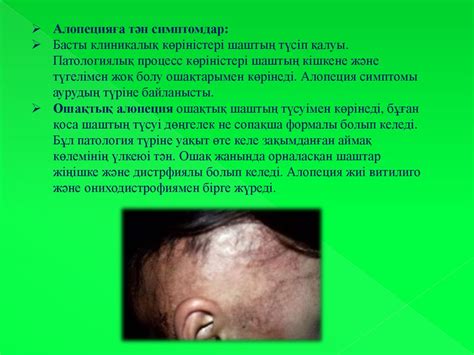 Алопеция - презентация онлайн