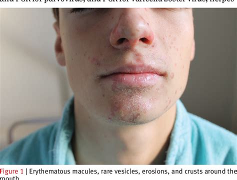 Hand Foot And Mouth Disease Adults Face