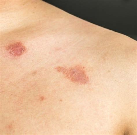 O Que Causa Micose Na Pele - Micose: causas, tipos e 7 dicas de prevenção - Minha Vida