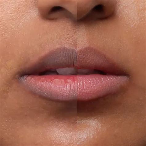 pink lips laser treatments nextmed clinic