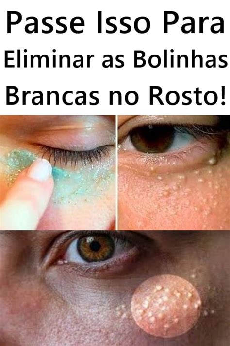 Pequenas Bolinhas No Rosto - Bolinhas Brancas no Rosto? Passe Apenas Isso Para Eliminar em Minutos ...