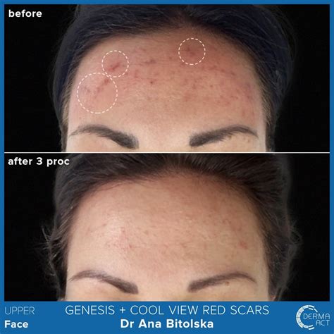 Белези от акне | Derma-Act