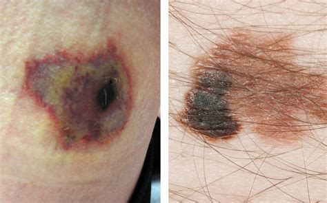 Brown Recluse Spider Bite First Few Days