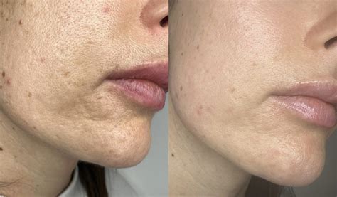 CO2 Laser Resurfacing - The Norwich Face & Body Clinic