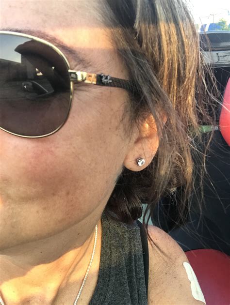how to get rid of a keloid on piercing 4