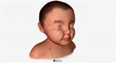 Quick Facts:Chickenpox - MSD Manual Consumer Version