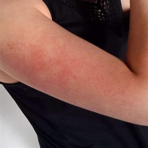 dark red spots  arm