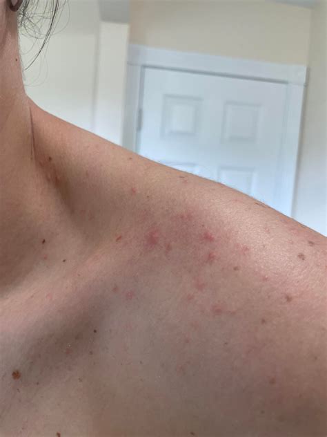 Is this bed bugs bites???? : r/bugs