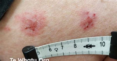 Discoid eczema image
