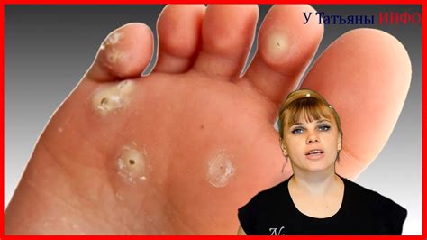 7 способов как избавиться от МОЗОЛЕЙ! - YouTube