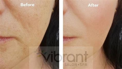 Injectable Wrinkle Fillers the best anti-aging treatment