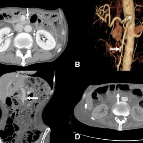(PDF) Three Cases of Spontaneous Isolated Dissection of the Superior ...