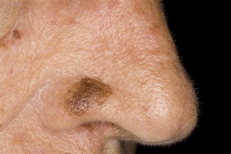 Лентиго меланома фото – 29 шт. / fotodiagnoz.com