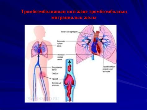 Өкпе артериясының тромбоэмболиясы. Терең көктамырлар тромбозы ...