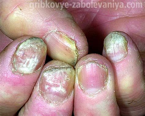 Ледяная уксусная кислота от грибка