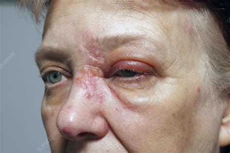 Top 18 First Stage Early Stage Shingles Symptoms Phot - vrogue.co