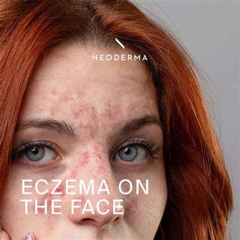 Eczema on The Face – NEODERMA