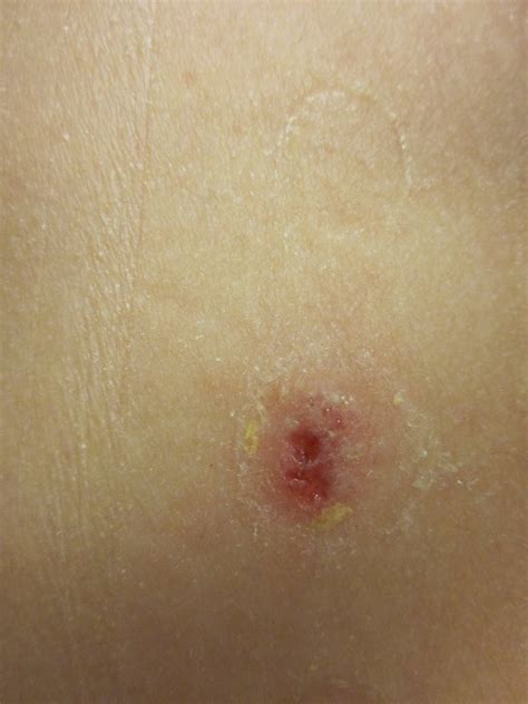 Allie's Abnormal Appetite: Allergy Test Results