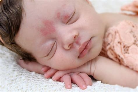 Meu Bebê Nasceu Com Uma Mancha Vermelha Na Testa - Bebê nasce com mancha de coração na testa, em SP, e faz sucesso na web