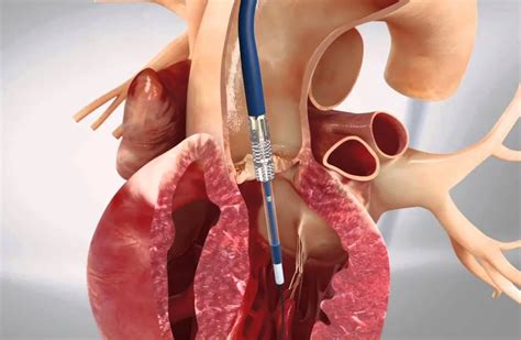 Implante de válvula aórtica por catéter “TAVI” – Revista Salud Médica